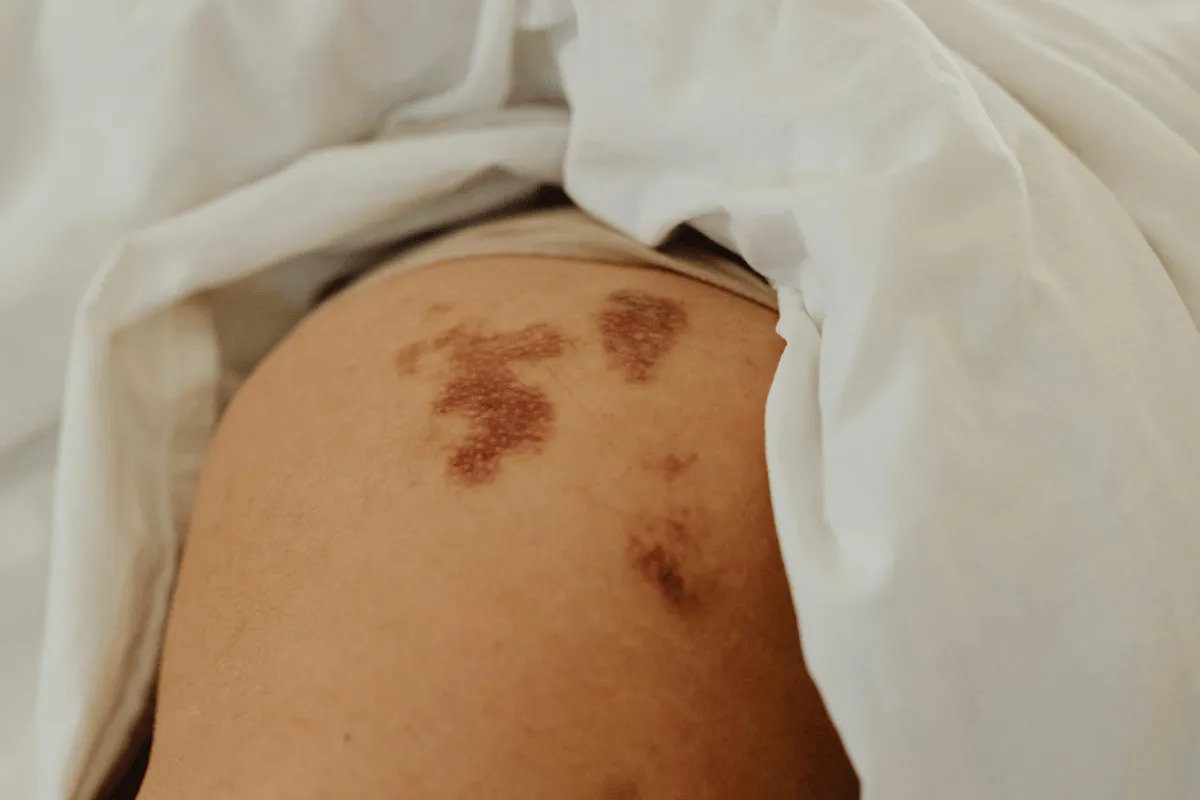 Detailed view of skin with healing scars under blanket.