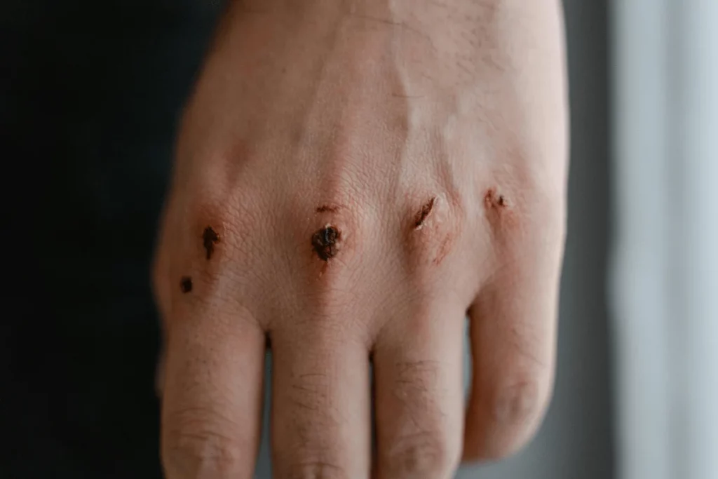 Close-up of a hand showing several small, dark wounds on the fingers, indicating possible injury or abrasion.