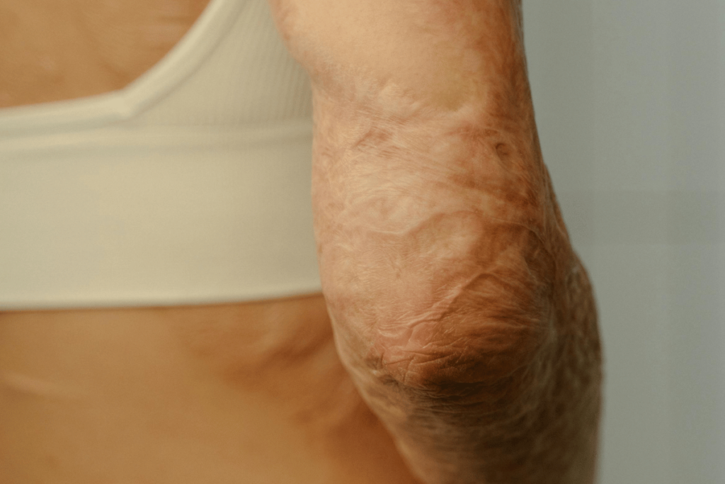 Elderly person’s arm showing scars.