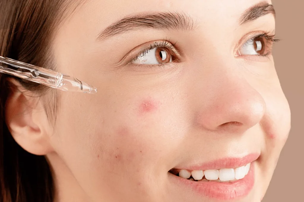 Woman applying serum to acne-prone skin with a glass dropper.